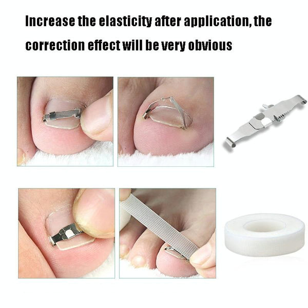 Orthopedic Buckle Toe Nail Groove Ingrown Nail Corrector, Style:No. 44, Specifications:Set