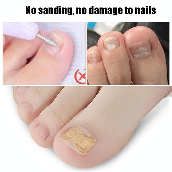 10 PCS Glue-free Orthopedic Nail Stick Toe Nail Groove Inlay Corrector(White Bottom)