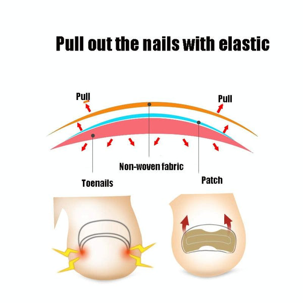 10 PCS Glue-free Orthopedic Nail Stick Toe Nail Groove Inlay Corrector(Transparent Bottom)