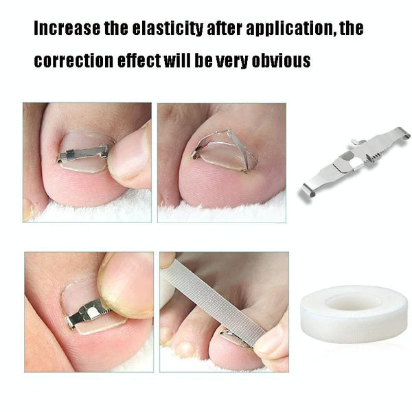 Orthopedic Buckle Toe Nail Groove Ingrown Nail Corrector, Style:No. 40, Specifications:Set
