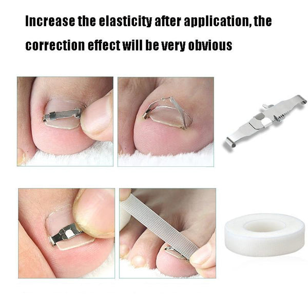 Orthopedic Buckle Toe Nail Groove Ingrown Nail Corrector, Style:No. 44, Specifications:Positive Nail Buckle