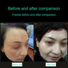 Handheld Picosecond Portable (Removing Tattoo Freckle Mole Dot)  Machine Laser Plasma Beauty Care Pen(Blue Light)