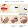 Breathable Acne Patch Concealer Invisible Sticker(Transparent)
